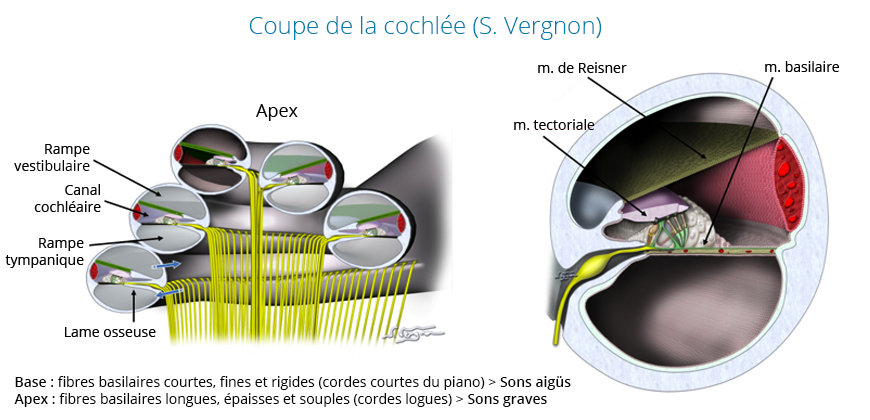 détérioration cochlée comme cause acouphènes