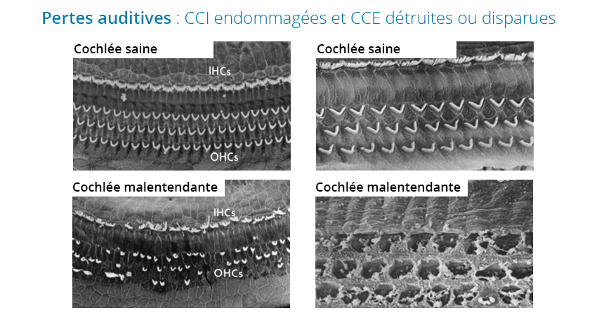 Acouphène Cause - Association Coopacou