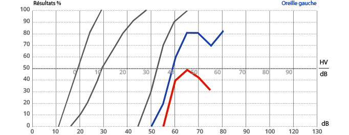 audiométrie vocale