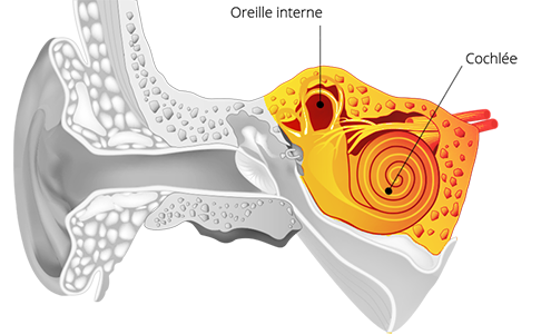 Surdité de perception problème cochlée ou oreille interne