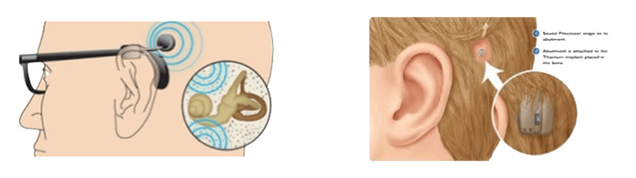 appareil auditif conduction osseuse