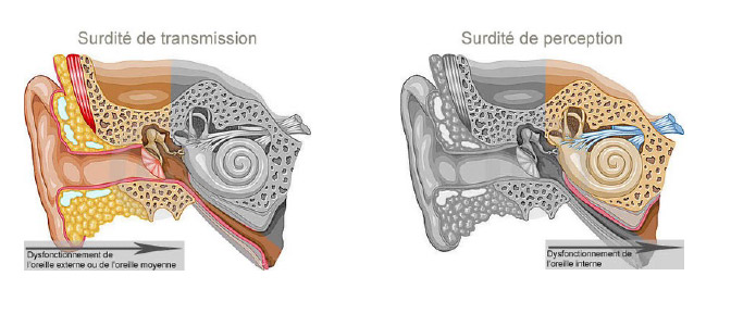 Surdité Mixte Définition | Association Coopacou