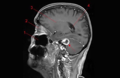 Neurinome du VIII