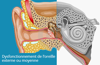 Définition Surdité de transmission